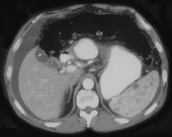 Splenic Hemangiomas - CTisus CT Scan