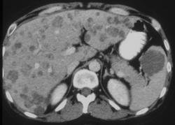 Lymphoma - CTisus CT Scan