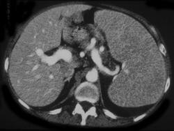 Lymphoma - CTisus CT Scan