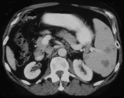 Splenic Metastases - CTisus CT Scan