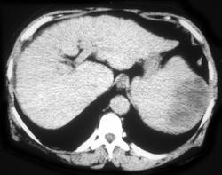 Splenic Lymphoma - CTisus CT Scan