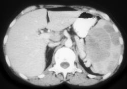 Splenic Lymphoma - CTisus CT Scan