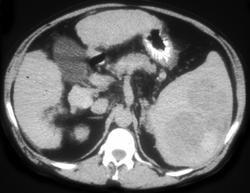 Splenic Lymphoma - CTisus CT Scan