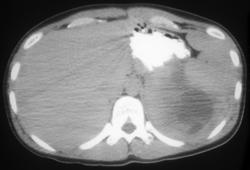 Splenic Infarction - CTisus CT Scan