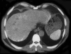 Thorotrast Spleen and Liver - CTisus CT Scan