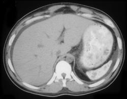 Sickle Cell Disease & Auto infarcted Spleen - CTisus CT Scan