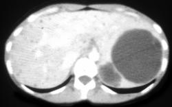 Splenic and Hepatic Cysts - CTisus CT Scan