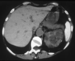 Thorotrast in Spleen - CTisus CT Scan