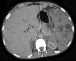 Splenic Hemangioma in Patient Klippel-Trenaunay-Weber (KTW) Syndrome - CTisus CT Scan