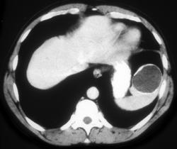 Calcified Splenic Cysts - CTisus CT Scan