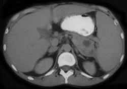 Pancreatitis Involves the Spleen - CTisus CT Scan