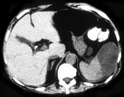 Splenic Infarction - CTisus CT Scan