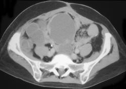 Ovarian Cancer With Implant in Pelvis & on the Spleen - CTisus CT Scan