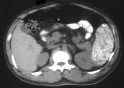 Pneumocystic Spleen - CTisus CT Scan