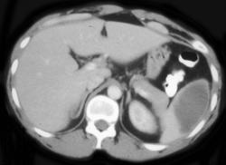 Splenic Infarction Which Became An Abscess - CTisus CT Scan