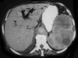 Lymphoma - CTisus CT Scan