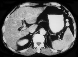 Lymphoma - CTisus CT Scan