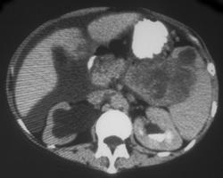 Splenic Metastases With Krukenberg Tumors - CTisus CT Scan