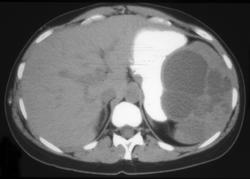 Splenic Cysts - CTisus CT Scan