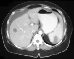 Splenic Infarction - CTisus CT Scan