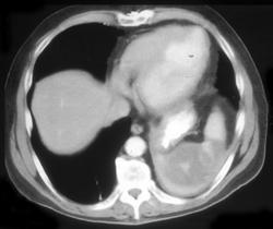 Splenic Infarction - CTisus CT Scan