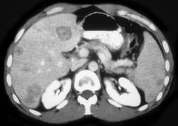 Melanoma to Liver and Spleen - CTisus CT Scan