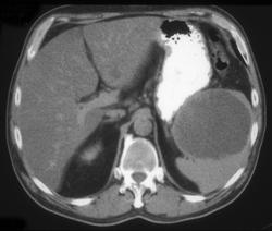 Splenic Cyst - CTisus CT Scan