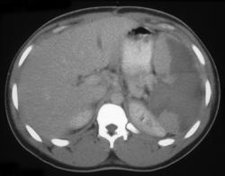 Splenic Infarction - CTisus CT Scan