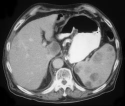 Lymphoma - CTisus CT Scan