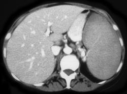 Splenic Infarction in Lymphoma - CTisus CT Scan