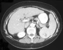 Splenic Hemangioma - CTisus CT Scan