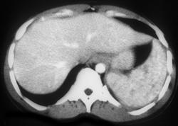 Tuberculosis (TB) - CTisus CT Scan