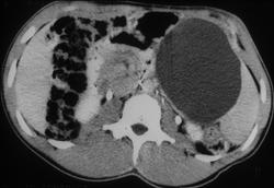 Splenic Cyst - CTisus CT Scan