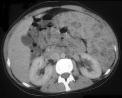 Splenic Hemangiomas - CTisus CT Scan