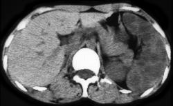 Splenic Angiosarcoma - CTisus CT Scan