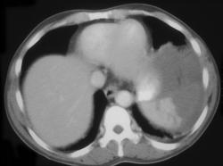 Splenic Laceration - CTisus CT Scan