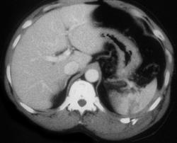 Splenic Laceration - CTisus CT Scan