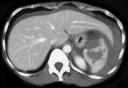 Splenic Laceration W/hemoperitoneum - CTisus CT Scan