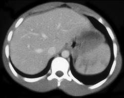 Splenic Laceration - CTisus CT Scan