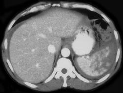 Splenic Laceration - CTisus CT Scan