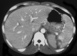 Splenic Laceration - CTisus CT Scan