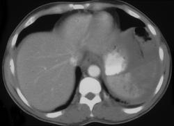 Splenic Laceration - CTisus CT Scan