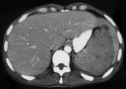 Lymphoma - CTisus CT Scan