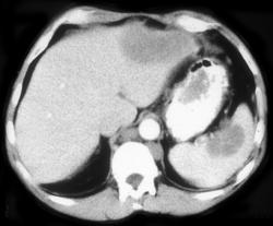 Ovarian Cancer - CTisus CT Scan