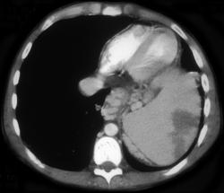 Splenic Infarction - CTisus CT Scan