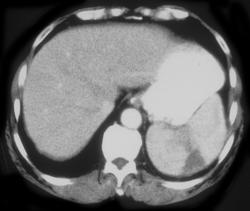 Splenic Infarction - CTisus CT Scan