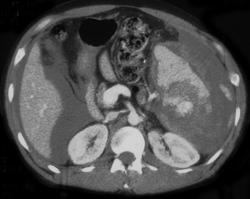 Splenic Lacerations - CTisus CT Scan