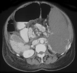 Splenic Infarction - CTisus CT Scan