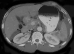 Splenic Laceration - CTisus CT Scan