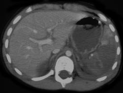 Global Infarction of the Spleen Due to Arterial Injury - CTisus CT Scan